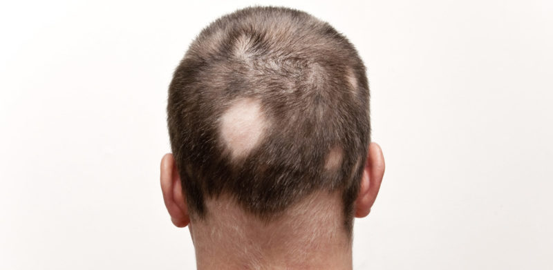 Alopecia Areata