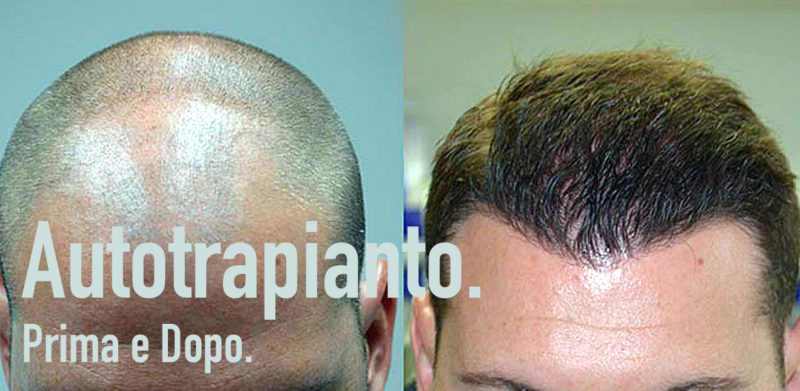 Autotrapianto Capelli Prima e Dopo