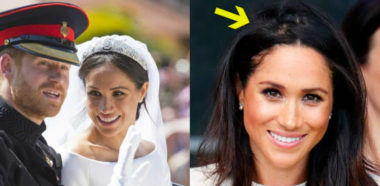 Meghan Markle e Calvizie