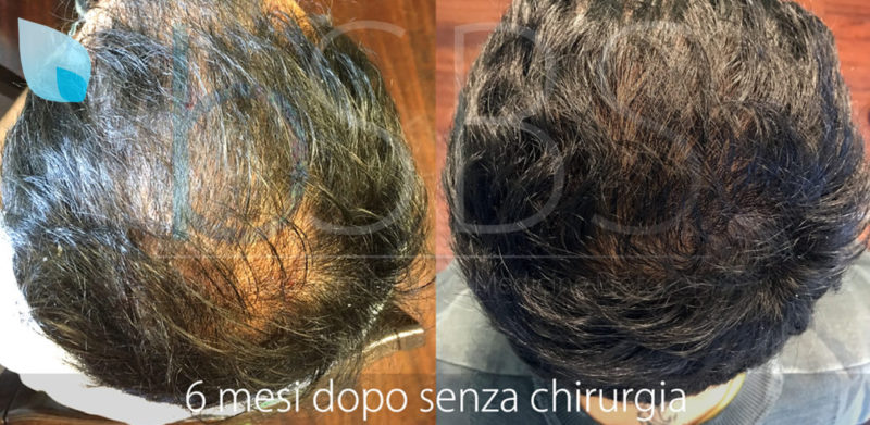 Alopecia e Cellule Immunitarie